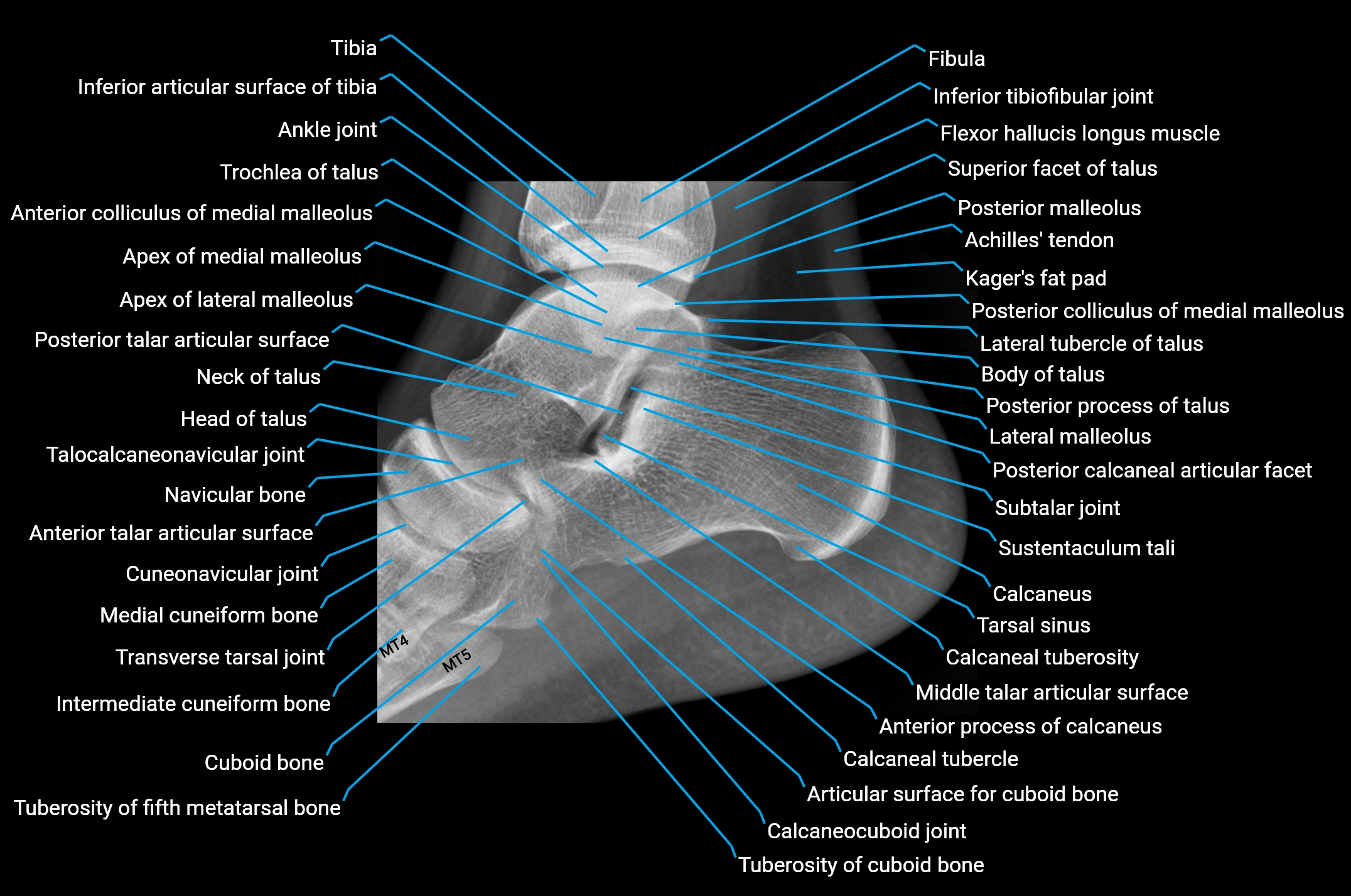 x ray calcaneus LAT anatomy.webp